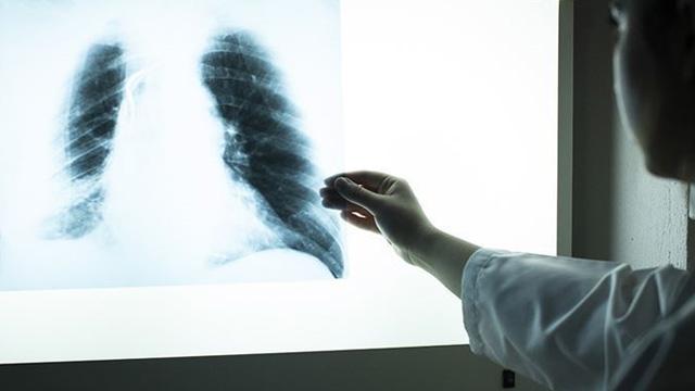 Pasif içicilerde yüksek "akciğer kanseri" riski