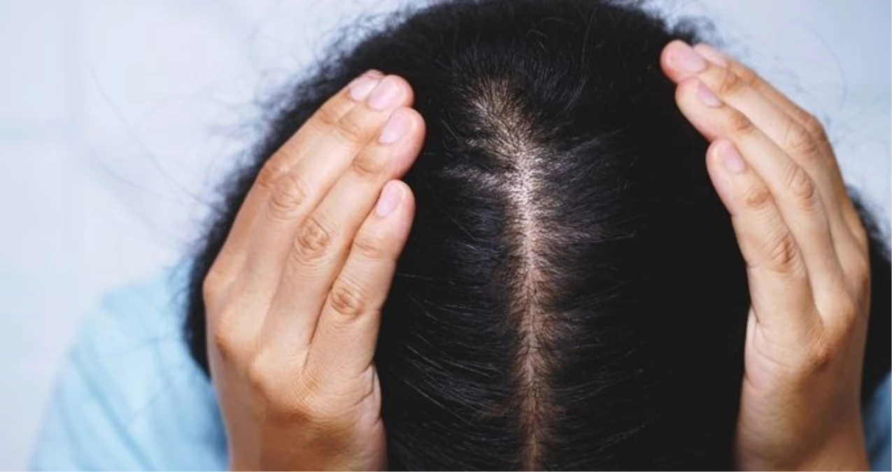 Saçta kepek neden olur? Saçtaki kepek nasıl geçer, tedavi teknikleri nelerdir, meskende ne yapılabilir?