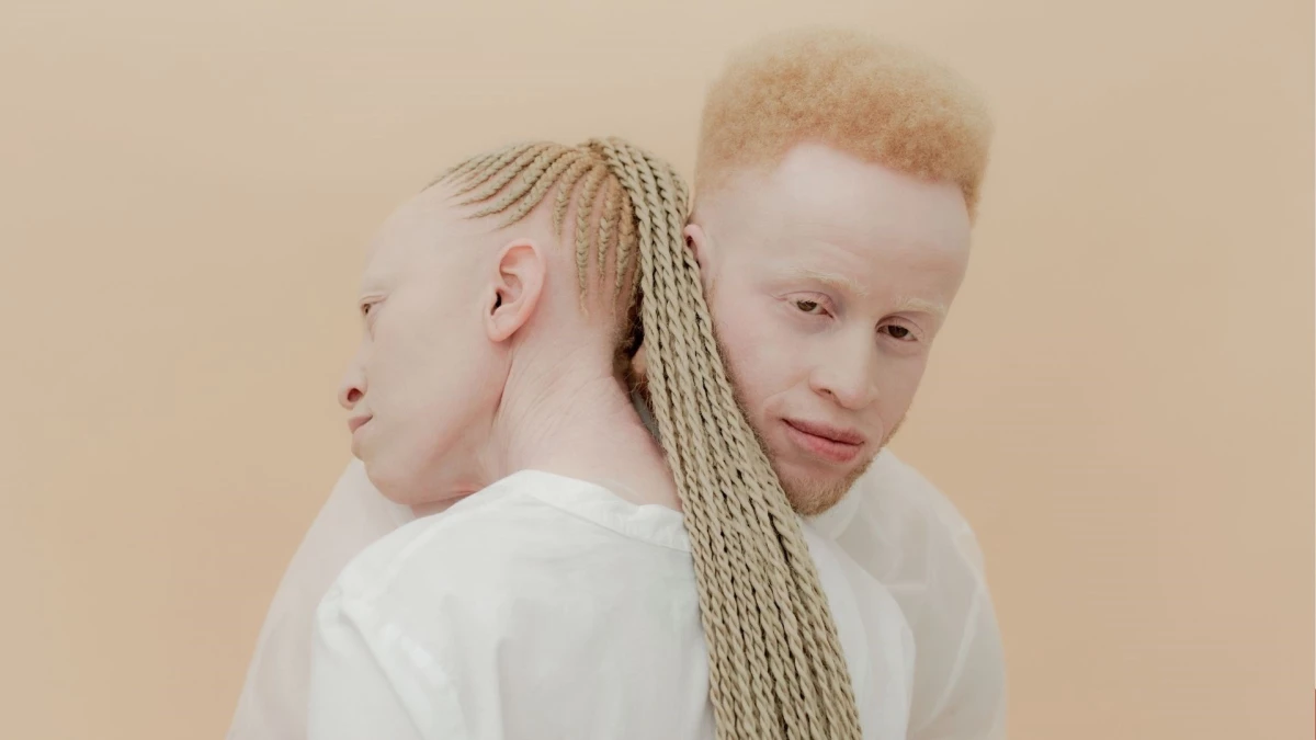 Albinizm nedir? Genetik hastalığın belirtileri, tedavisi ve toplumsal farkındalık